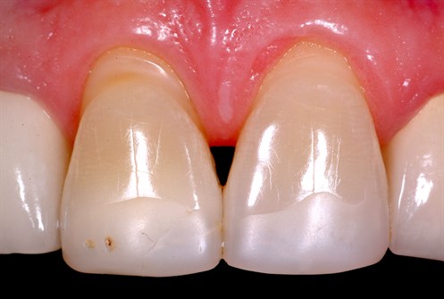Bioclear dentist atlanta Atlanta dentist bioclear