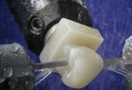 Cerec Same-Day Crowns Atlanta Dentist One-Visit Crowns Same-Day Crown Atlanta Dentist