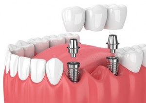 Atlanta Dentist dental-bridge Atlanta Dentist Same Day Crowns