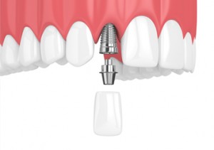 Atlanta Dentist dental-implants Atlanta Dentist Same Day Crowns