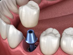 dental-implants-atlanta-georgia Atlanta Dentist Dental Implants