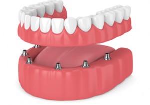 Atlanta Dentist denture-implants Atlanta Dentist Same Day Crowns