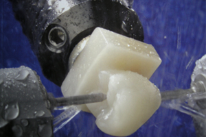 Cerec-One-Visit-Crowns-Atlanta Dentist Atlanta Dentist Same Day Crowns