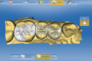 Emergency-Crown-Same-Day Atlanta Dentist Cerec - Same Day Crowns Atlanta Dentist